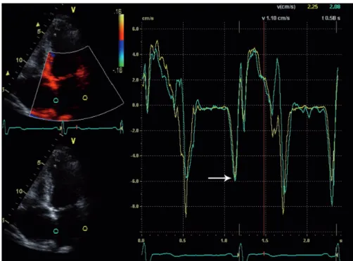 Figure 10. Tissue velocity echocardiography (TVE). 