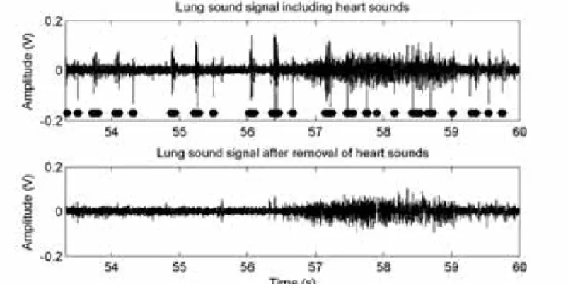 Fig. 1.4: Example of a lung sound signal before and after heart sound cancellation.