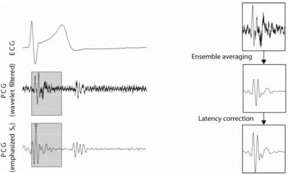 Figure 1. Example showing the predefined window (grey boxes) in the PCG. The window ranges  from the R-peak in the ECG and have a width of 250 ms