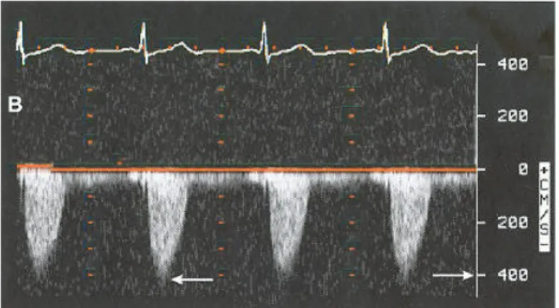 Fig 2. Dopplerregistrering över aortaklaffplanet. Pilen till vänster visar maximala systoliska  flödeshastigheten, som enligt skalan till höger ligger på 400 cm/s eller 4 m/s