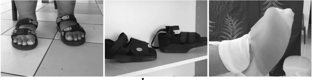 Figure  3. Three  different  orthotic  devices,  a) sandal  with  insole,  b) heal-  and  forefoot  off- off-loader, c) rigid non-removable foot orthosis
