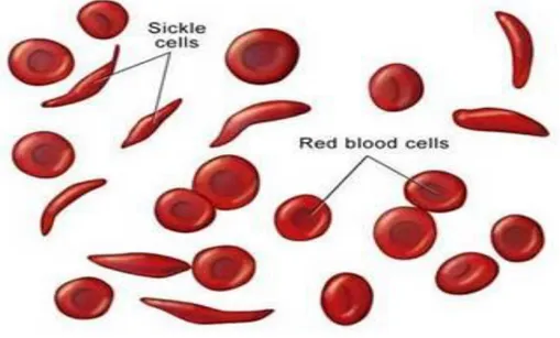 Figure 1: Shows a normal red blood cells and an abnormal red blood cells in Sickle cell  disease (20)