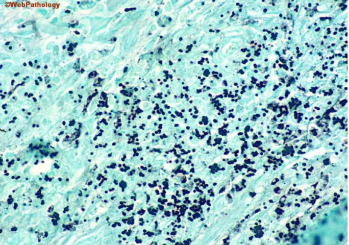 Figur 2. Histoplasma infärgade med Grocott ses i figuren som coccoida strukturer i kluster(13)