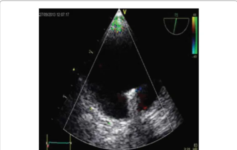 Table 1: Patient characteristics: M = Male, F = Female, NYHA = New York  Heart  Association,  AS  =  Aortic  Stenosis,  AI  =  Aortic  Insufficiency,  MI  =  Mitral  Insufficiency, CAD = Coronary Artery Disease, AVR = Aortic Valve Replacement,  TAVR = Tran