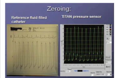 Figure 4 shows an original LA pressure recording from the sensor  after open chest cardiac surgery with baseline variation synchronous  with the patient´s respiration