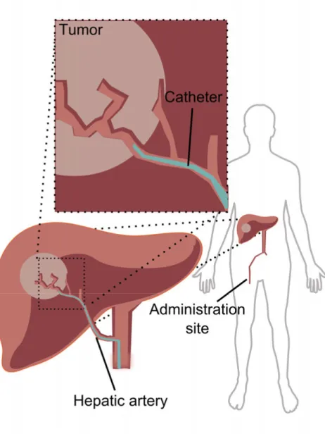 Figure 1. Schematic illustration of the transarterial chemoembolization (TACE)   administration site in hepatocellular carcinoma (HCC) treatment