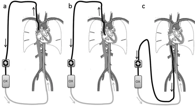 FIG. 3. Overview of cannulation: a) vena cava superior to descending aorta (VCS ! DA), b) right atrium to descending aorta (RA ! DA) and c) vena cava inferior to descending aorta (VCI ! DA).