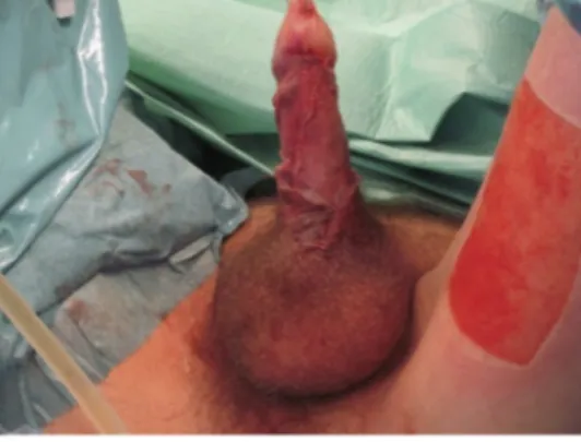 Fig. 1. Degloved penis, skin still attached through a small bridge at the base, 24 h after injury.
