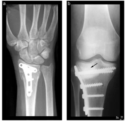 Figure 2. a) The author’s wrist after an adventurous day of snowboarding in the  Swedish mountains, showing fracture fixation using a metallic plate and screws