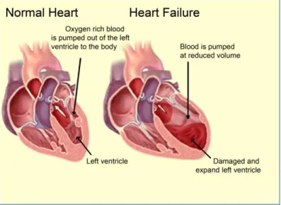 Figure 1. LVHF. (The picture modified by author from http://www.semashko.com)