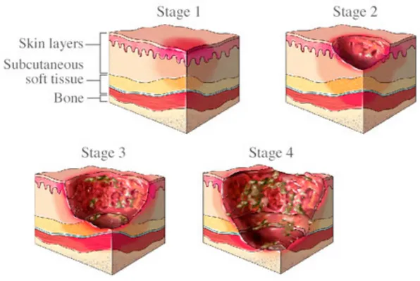 Figure 2. Schematic images of pressure ulcers stages [Figure 2] 