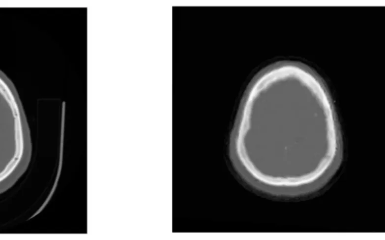 Fig 3: Difference between CT and SCT image in the same slice, left picture is CT and the right one is SCT 