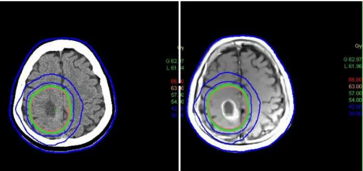Figure 13 and Figure 14 show the comparisons of the  tumor isodose distributions for the CT image  slice in CT calculations and MR image slice of the same patient for SCT calculations respectively