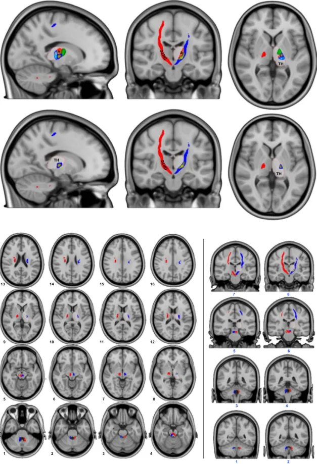 Fig. 2. The left (blue) and right (red) dentato-rubro-thalamo-cortical tracts shown with decussation in the midbrain and path through the thalamic clusters