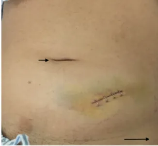 Fig. 1. Left iliac fossa mini-incision on post operative day 4 (Short arrow: umbilicus, Long arrow left anterior superior iliac spine).