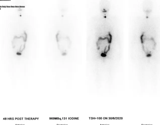 Fig. 7. Post low-dose radioactive iodine therapy whole body scan showing small amount of activity in the thyroid bed.