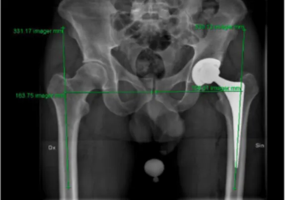 Figure	 5: 	 A	 radiolographic	 measurement	 of	 the	 global	 FO	 according	 to	 Sundsvall	 method.	 A	 horizontal	 distance	 between	 the	 femoral	 axis	 (a	 line	 drawn	 through	 the	 centre	 of	 the	 femoral	 shaft)	and	the	midline	of	the	pelvis	at	the	