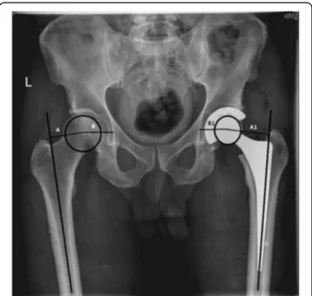 Fig. 1 Plain radiograph measurement of the global FO by adding the distance between the longitudinal axis of the femur and the centre of the femoral head (femoral offset) to the distance from the centre of the femoral head to a perpendicular line passing t