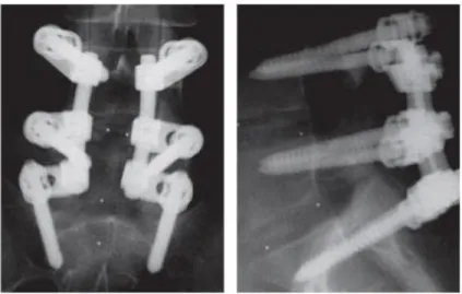 Figure 1.9: Posterior (left) and lateral (right) views of fusion with posterior application of rods  and pedicle screws to L4-S1 (Rutherford, et al., 2007)