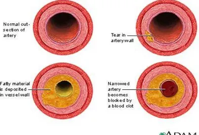 Figure 7 - Accumulation of cholesterol in the artery. Source: 