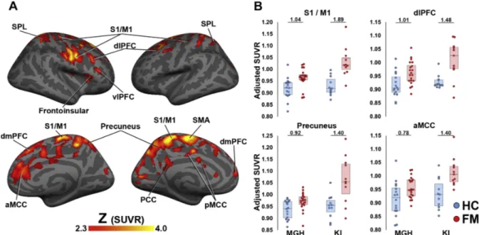 Fig. 2. Voxelwise group diﬀerences in [ 11 C]PBR28 SUVR A. Surface projection maps displaying areas with significantly elevated [ 11 C]PBR28 SUVR in FM patients compared to controls (FM – n = 31; HC – n = 27), in voxelwise analyses (KI + MGH sample)