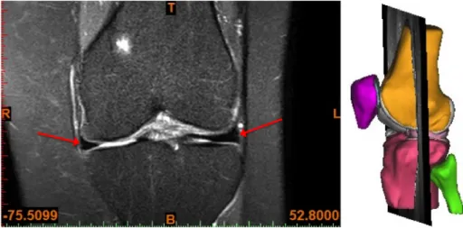 Figure 2.4: A PD FS 2D MR image of the knee joint in the coronal plane, with both menisci pointed out with red arrows