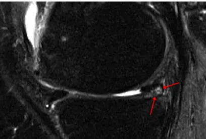 Figure 2.6: MRI signal changes in the meniscus pointed out with red arrows.