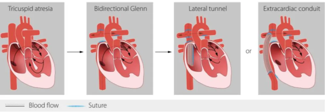 Figure 3. Surgical stages of Fontan circulation.  