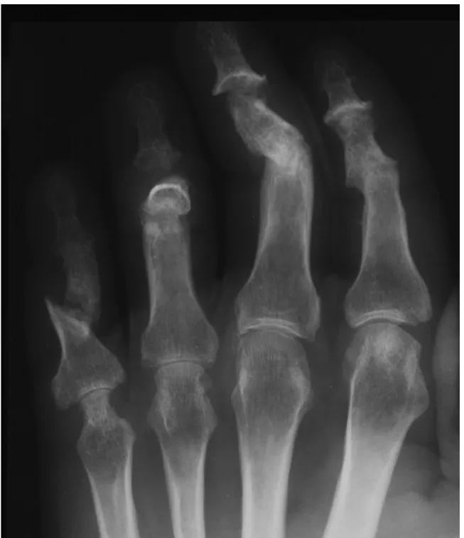 Figure 1. Radiographic examination of the hand showing; ankylosis of the  PIP-joints II, III and DIP-joint V, arthritis mutilans in DIP-joint IV, whittling  and cupping in DIP-joint III, severe erosions in MCP-joints IV and V, and  pseudostoarthritis dig V