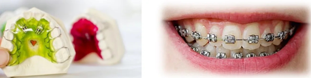Figur 2. Klammerplåt (till vänster) är exempel på en avtagbar tandställning som ofta  används i  allmäntandvården