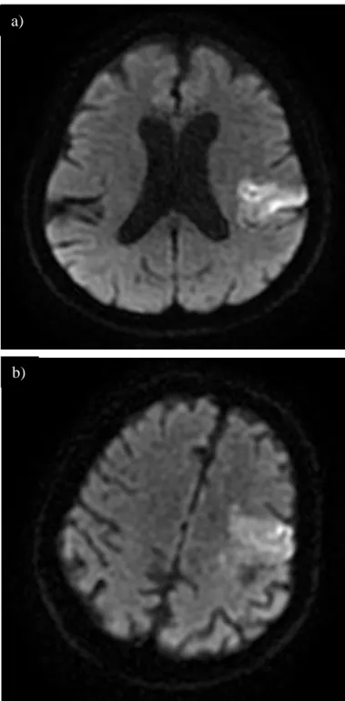 Figure 1. CT and MRI scans of patients approximately 24 hours after thrombolysis. a)  Diffusion-weighted imaging (DWI) scan of Patient 1, showing left MCA territory cortical  ischaemia