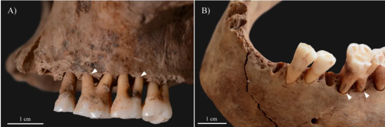 Fig 5. Alveolar bone recession (white arrows) of the A) maxillary and B) mandibular teeth of KK61, with ante-mortem loss of the mandibular central incisors.