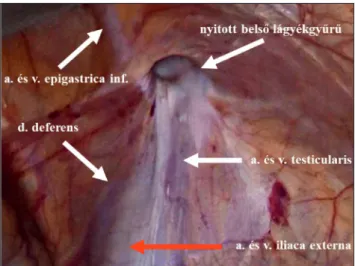 1. ábra: A jobb oldali lágyéktáj intraabdominalis anatómiája, nyitott belsõ lágyékgyûrû