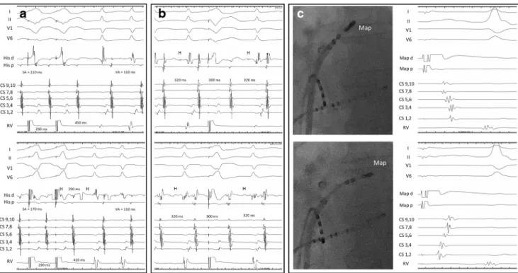 Fig. 1 Surface ECG leads I, II, V 1 , and V 6 , together with intracardiac recordings from the His bundle region (His d and His p), proximal to distal coronary sinus (CS 9,10 - CS 1,2), and right ventricle (RV).