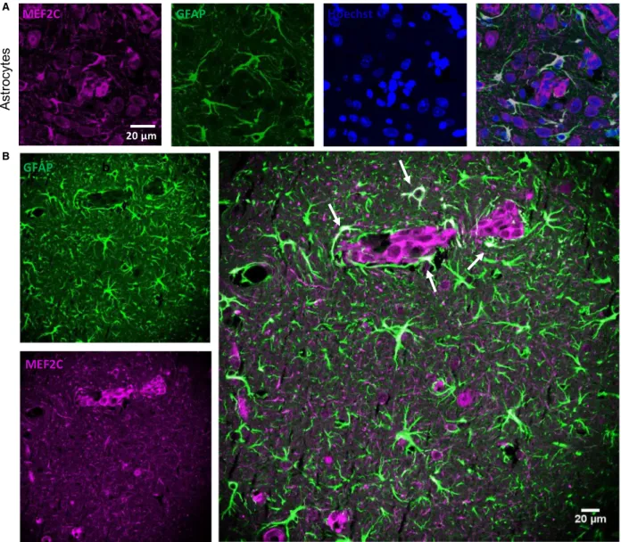 Fig. 6. Myocyte enhancer factor 2C (MEF2C) expression in the peritumoral astrocytes. Brain sections from 4T1-injected mice were analyzed, to study the expression of MEF2C in nontumoral cells, in close proximity to tumor cells