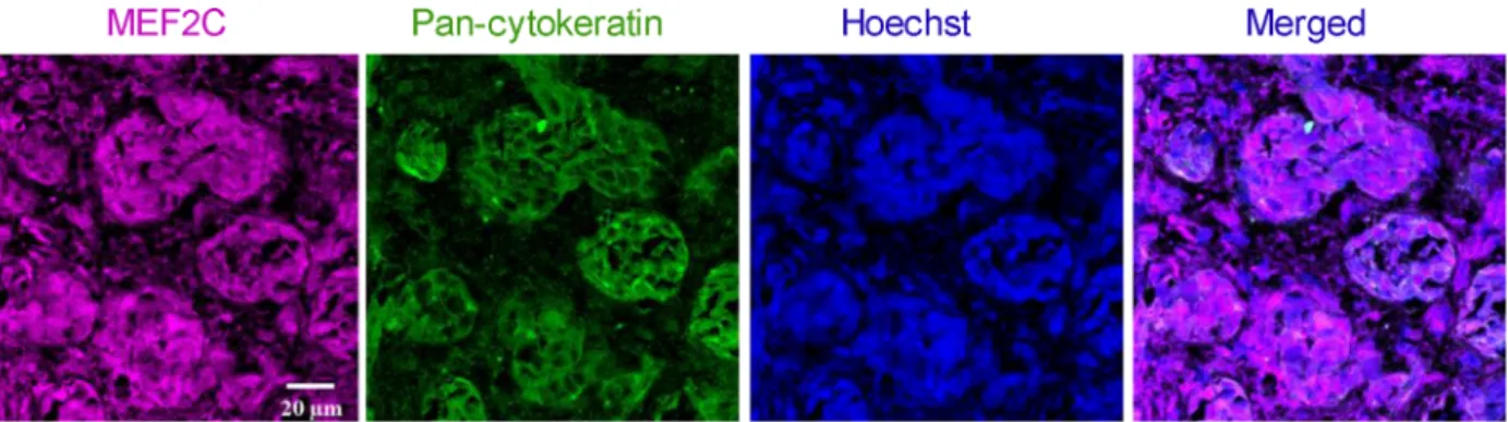 Fig. 7. Myocyte enhancer factor 2C (MEF2C) expression in human brain metastases from triple-negative breast carcinoma