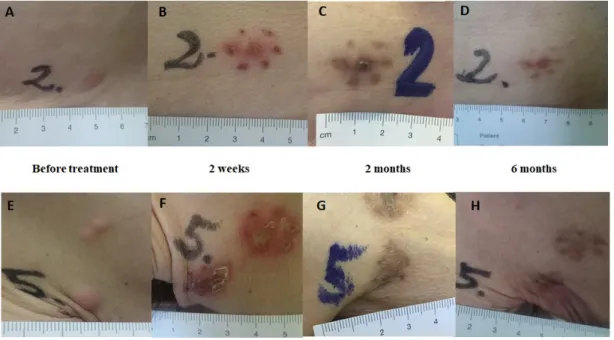 Figure  5. Clinical  response. Clinical response  after  Ca‐EP; clinical  response  after bleomycin‐based  ECT. The lesions are  from  patient  no.2 with  cutaneous  metastases  from  breast cancer in  the  same  region (trunk). Lesion no. 2: Ca‐EP treated