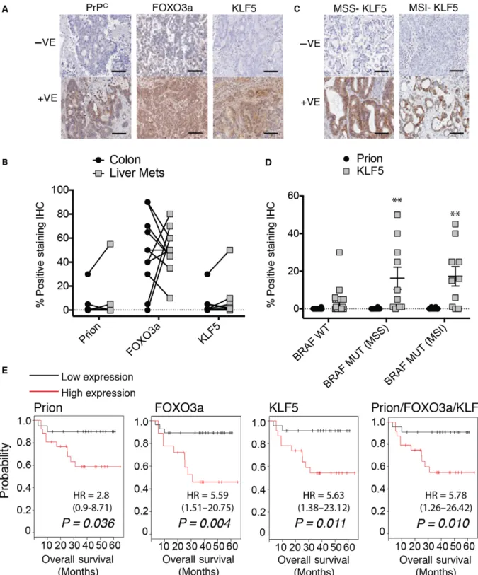 Fig. 4. The PrP C /FOXO3a/KLF5 axis expression correlates with colorectal cancer patient progression and is a marker for outcome
