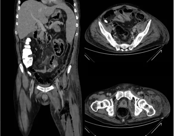 3. ábra Az 1. esetnél az első posztoperatív napon végzett CT-vizsgálat a bal oldali femoralis régióban kiterjedt tályogrendszer képét mutatta