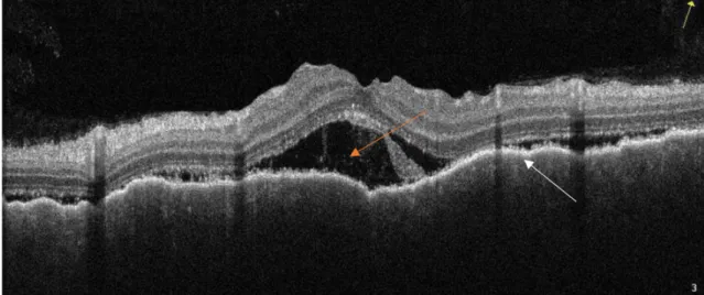 2. ábra Első betegünk jobb szemének macula-OCT-felvétele: subretinalis folyadék (sárga nyíl) és a pigmenthám egyenetlen lefutása, redőzöttsége   látható (fehér nyíl)