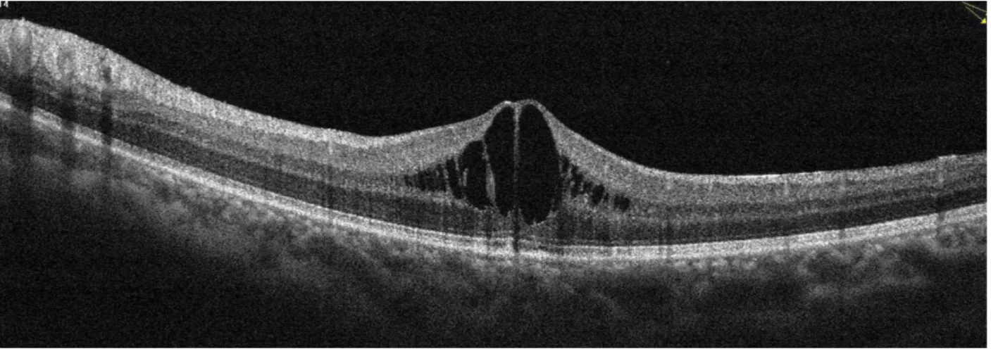 5. ábra Második betegünk bal szemének macula-OCT-felvétele: cystoid maculaoedema ábrázolódik OCT = optikaikoherencia-tomográfia