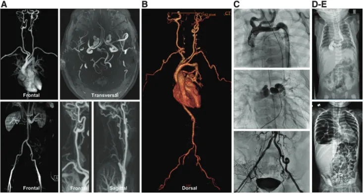 FIG. 2. Imaging studies in five patients with arterial tortuosity syndrome. (A) Magnetic resonance angiography in patient A shows moderate to severe tortuosity of the supra-aortic arteries, including the carotid, the basilar and cerebral arteries, and both
