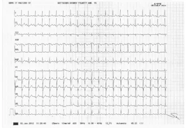 1. ábra Inadekvát, aránytalan sinustachycardia jellegzetes EKG-képe  (A P-hullám pozitív az I-, II-, VF-, V2–5-elvezetésekben,  nega-tív a VR-ben, pozinega-tív vagy bifázikus a III-, V1- és  VL-elvezeté-sekben