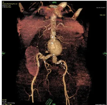 1. ábra Preoperatív CTA-felvétel: infrarenalis aortaaneurysma; a bal  AIC kezdeti szakaszának aneurysmaticus tágulata; transzplantált  vese a jobb fossa iliacában