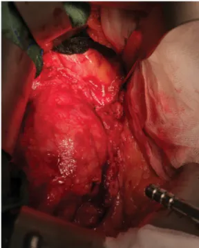 2. ábra Intraoperatív felvétel: az infrarenalis aortaaneurysma