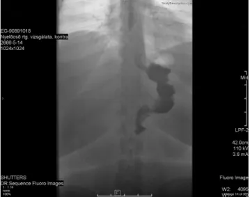2. ábra Nyelési röntgenvizsgálat négy héttel a műtétet követően