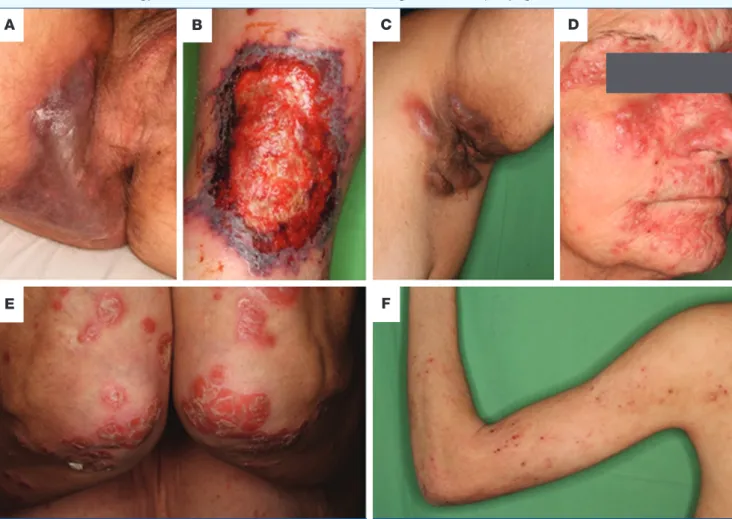 1. ábra: Gyulladásos bélbetegséghez kapcsolható bőrgyógyászati betegségek 