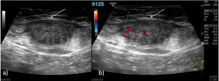 3. ábra A lineáris transzducerrel (8,5 MHz) készített felvételeken jól látható a rectusizomban detektált echószegény, vascularisalt képlet (a, b; nyilak jelölik az  elváltozást), melynek a szövettani diagnózisa endometrioma volt