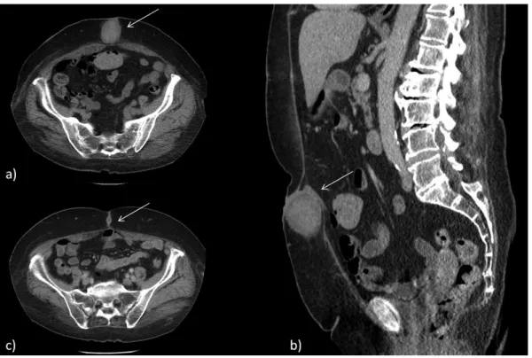 8. ábra A 76 éves nőbeteg CT-leletén hasfali, periumbilicalis elhelyezkedésű terime látható (a, b; nyíl)