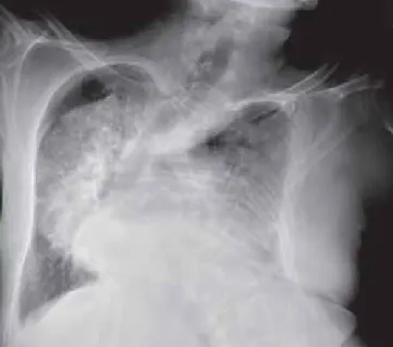 1. ÁBRA. Mellkasröntgen – súlyos mellkas- és gerincdefor- gerincdefor-mitás, jelentős cardiomegalia